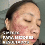 CLEARSTEM: Suplemento para el control del acné hormonal