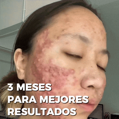 CLEARSTEM: Suplemento para el control del acné hormonal